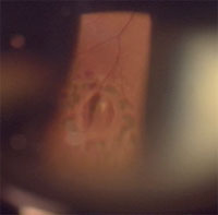 レーザーが行われた網膜裂孔写真